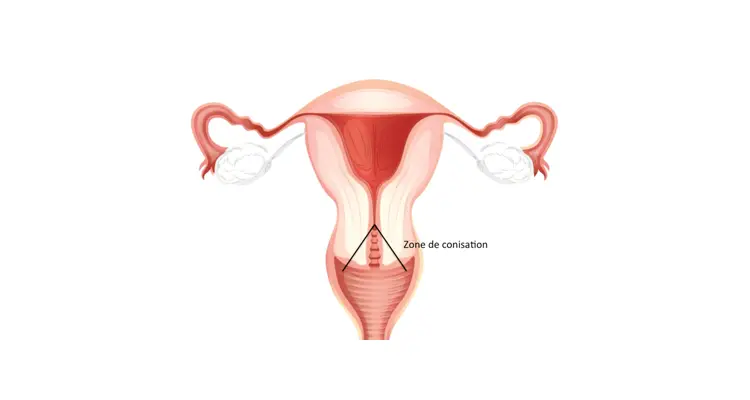 Papillomavirus stade 3 conisation